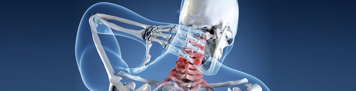 Osteochondrosis tina tulang tonggong serviks manusa