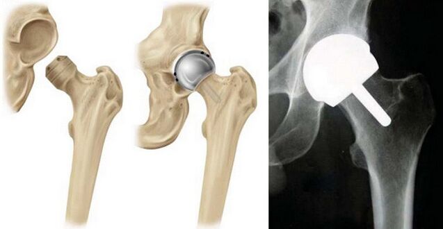 Artroplasti hip