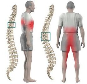 Nyeri nganggo chaRachosis Thoracic tiasa dipasihan ka anggota awak handap sareng crotch
