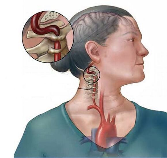 sindrom arteri vertebral sareng osteochondrosis cervical