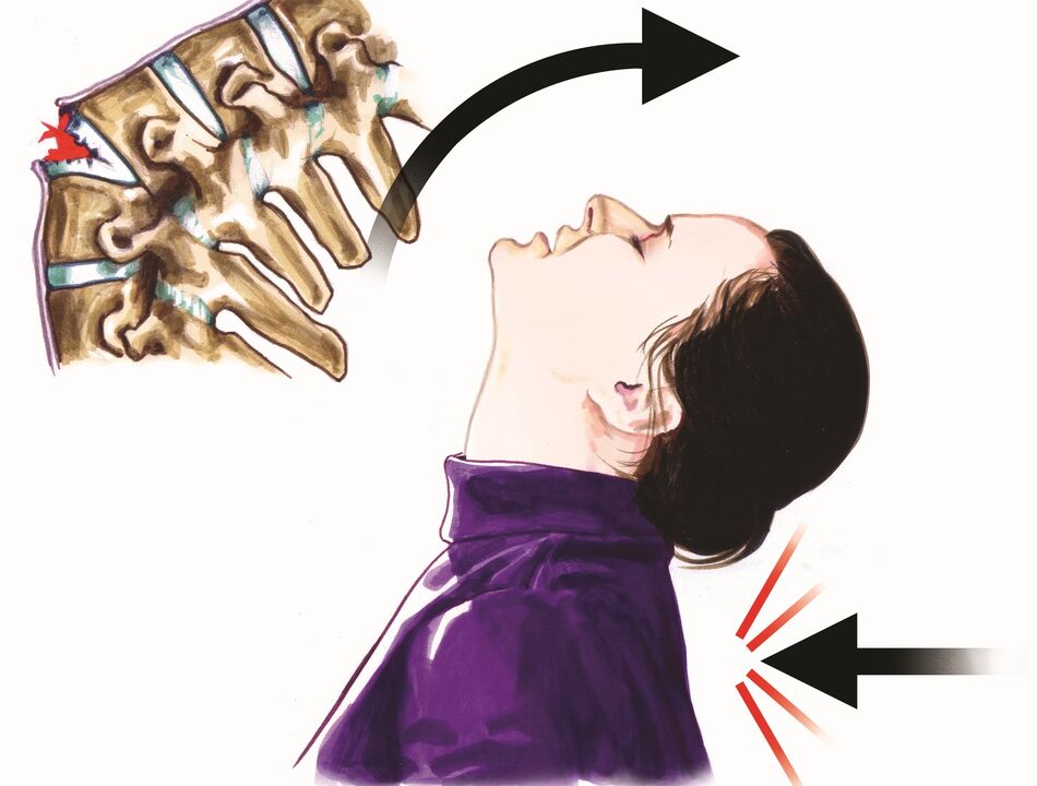 ruksakna tulang tonggong salaku ngabalukarkeun nyeri beuheung