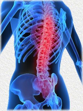 osteochondrosis jeung métode perlakuan na