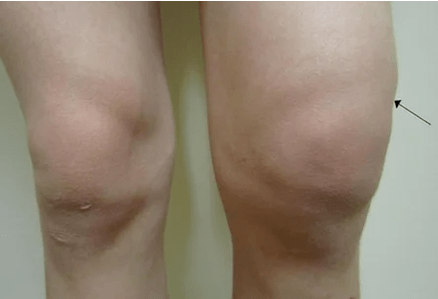 Hemarthrosis tina sendi dengkul